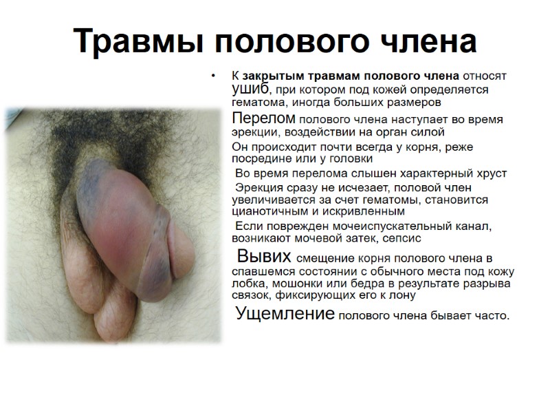 Травмы полового члена К закрытым травмам полового члена относят ушиб, при котором под кожей